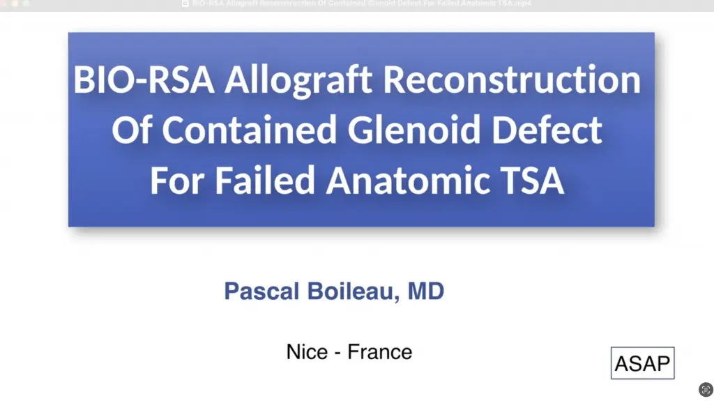BIO-RSA Allograft Reconstruction Of Contained Glenoid Defect For Failed Anatomic TSA