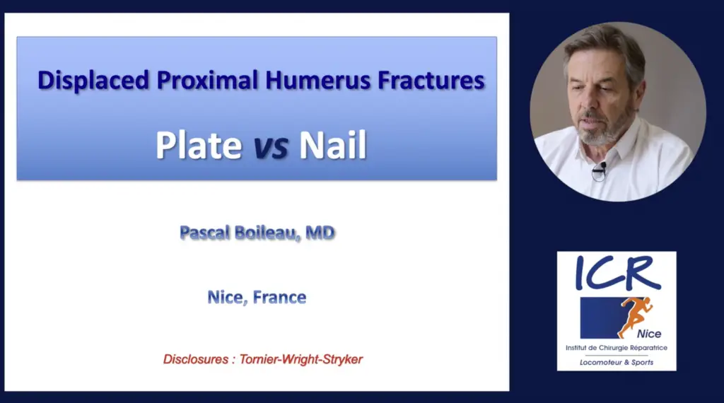 Displaced Proximal Humerus Fractures Plate vs Nail