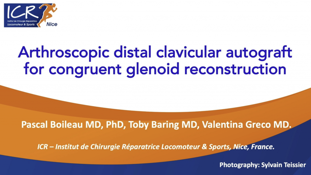 Arthroscopic Distal Clavicular Autograft for Congruent Glenoid Reconstruction