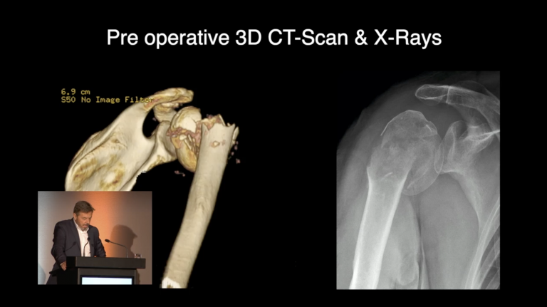 Re-Live Surgery RSA for Displaced 4-Part Fracture